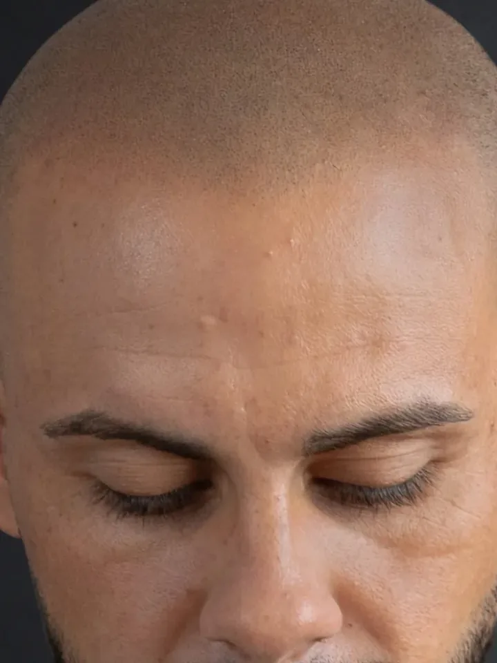 Nachher: Frontansicht vor und nach der Haarpigmentierung