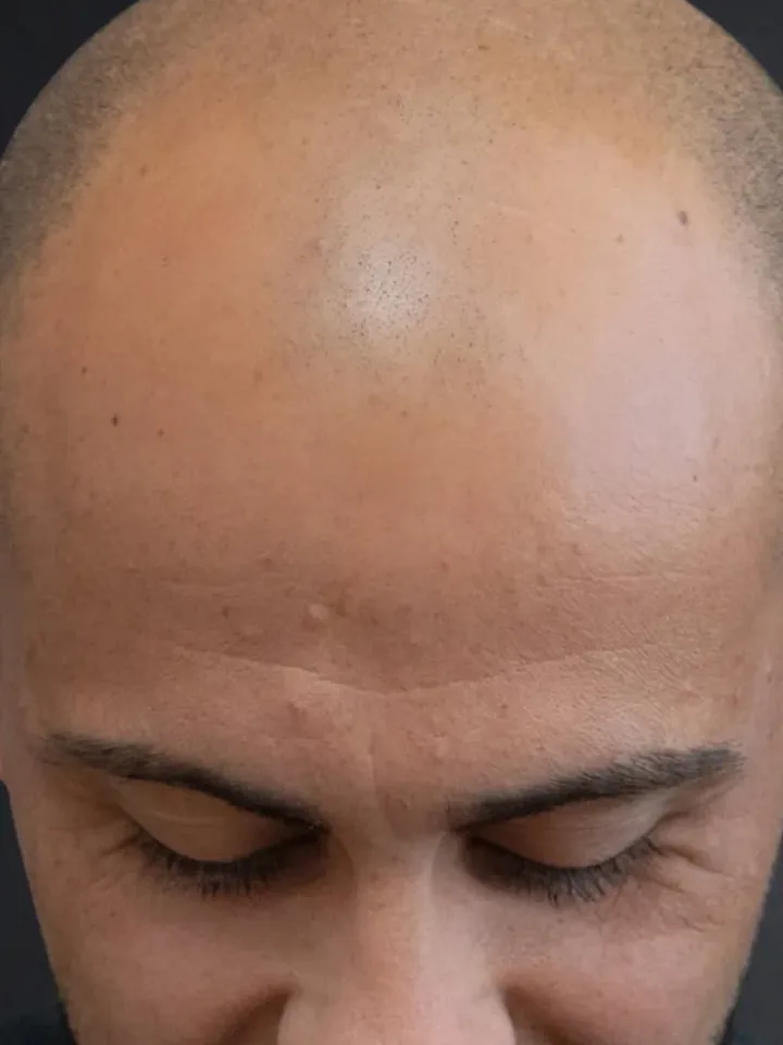 Vorher: Frontansicht vor und nach der Haarpigmentierung