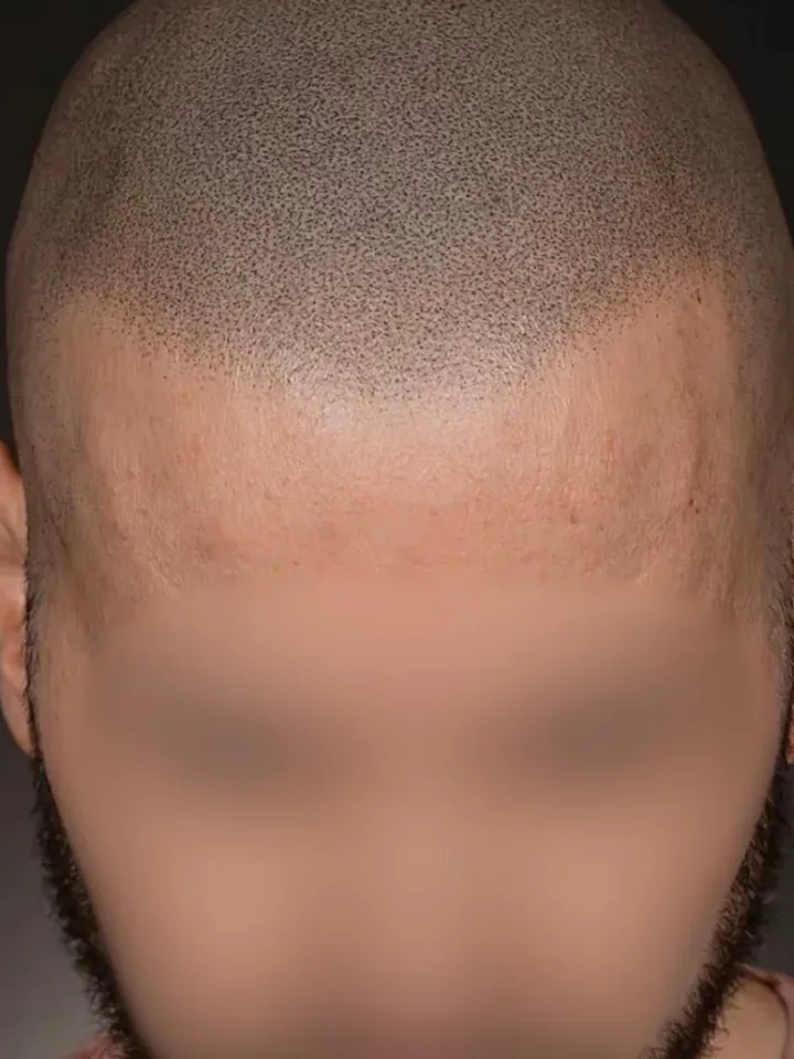 Nachher: Oberkopf vor und nach der Haarpigmentierung