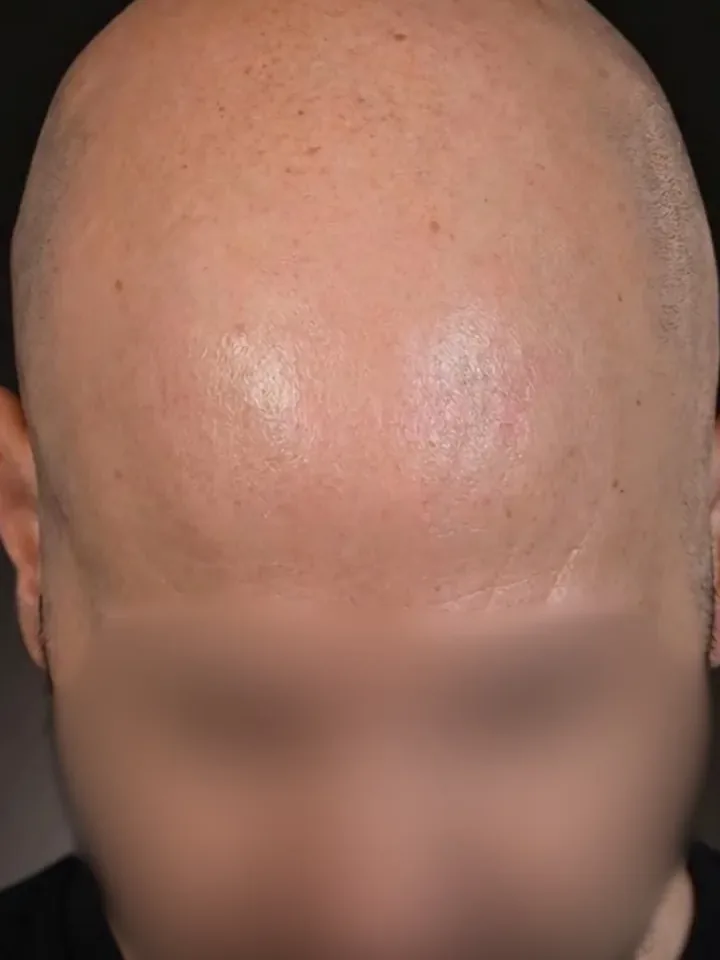 Vorher: Oberkopf vor und nach der Haarpigmentierung