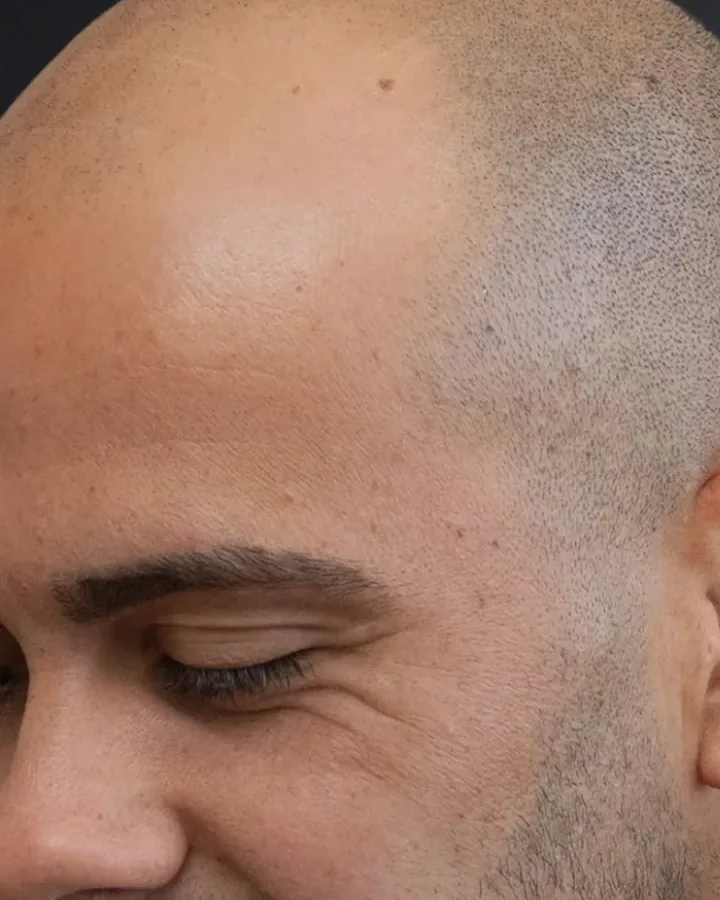 Vorher: Seitenansicht vor und nach der Haarpigmentierung