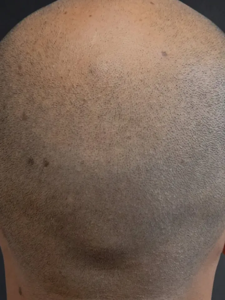 Nachher: Tonsur am Hinterkopf vor und nach der Haarpigmentierung