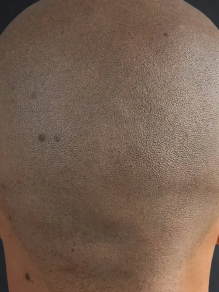Vorher: Tonsur am Hinterkopf vor und nach der Haarpigmentierung